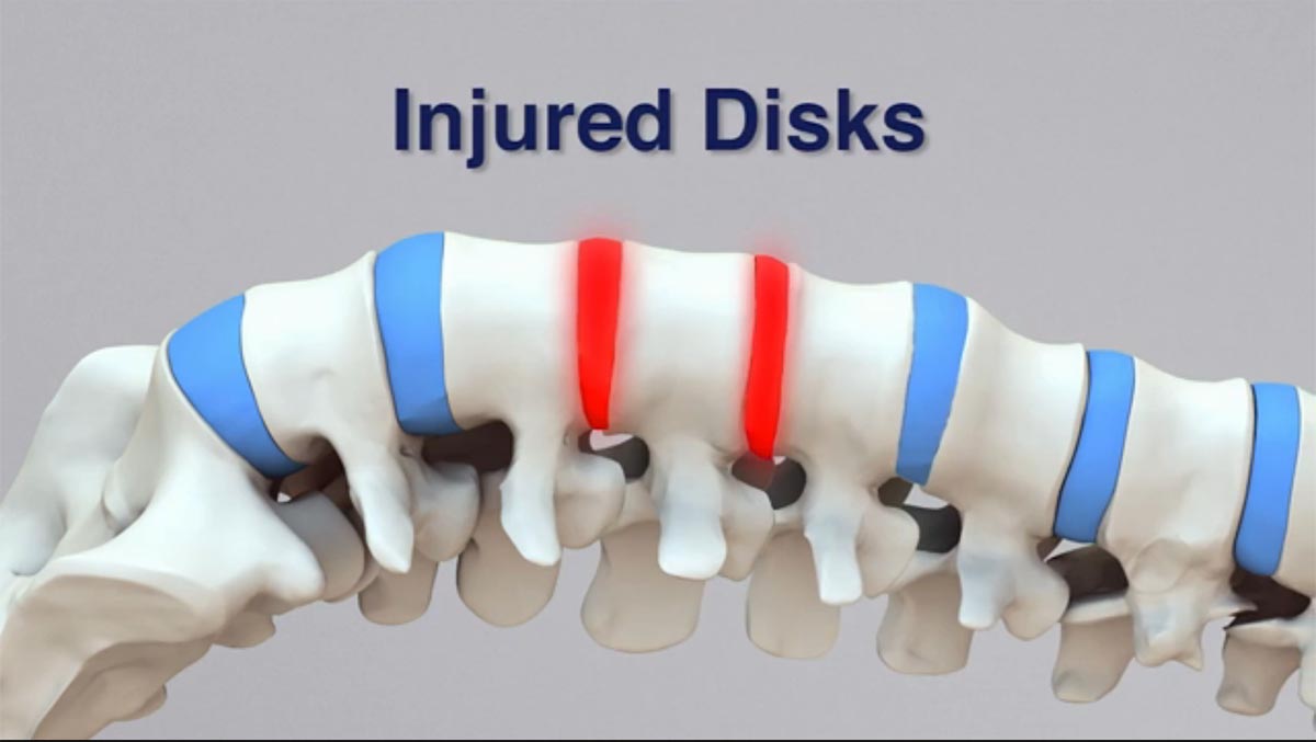 New Carrollton non-surgical spinal decompression